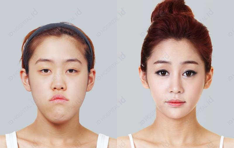 眼部整形医院排名_眼部整形前后对比图