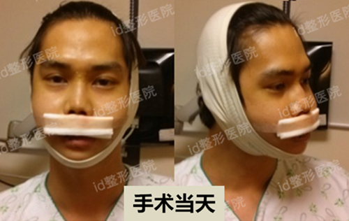 韩国id医院双鄂手术，下颌角整形手术当天
