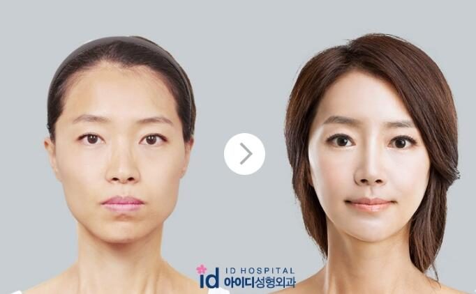 韩国id医院下颌角整形前后对比照片