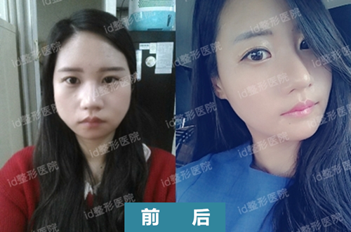 韩国id医院面部轮廓vline手术前后对比照片