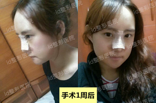 韩国id医院下颌角整形手术一周后的照片