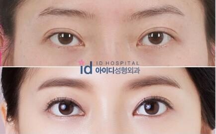 韩国id医院埋线双眼皮恢复图片