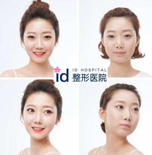 id医院，韩国整形手术，面部轮廓，vline手术