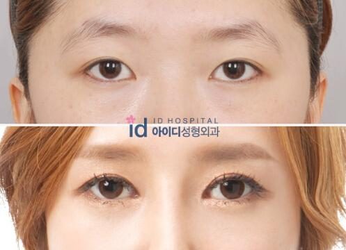 韩国id医院，双眼皮手术，去韩国整形