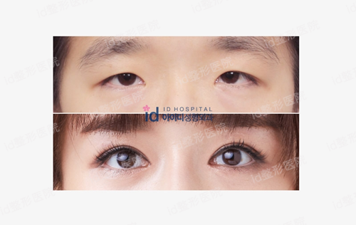 韩国整容医院双眼皮手术前后对比照片