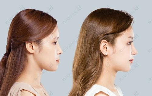 韩国id整形医院隆鼻和双眼皮手术前后对比照片