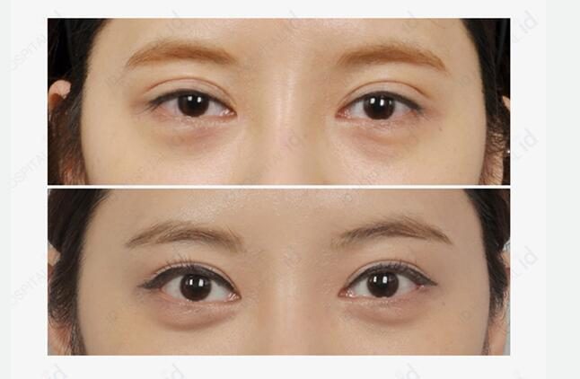 韩国整形医院双眼皮修复手术前后对比照片