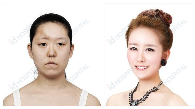 韩国整形医院双重紧贴额头假体前后对比照片