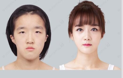 韩国双眼皮手术