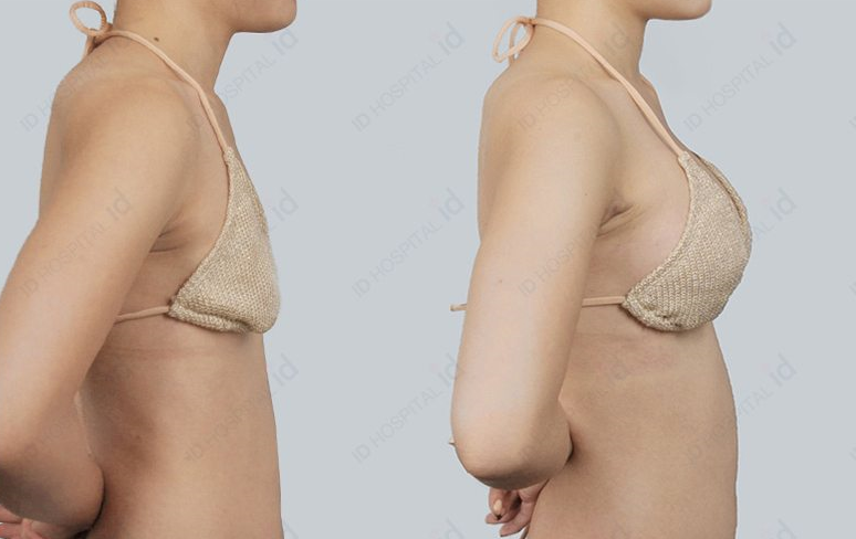 id韩国整形医院胸部整形前后对比
