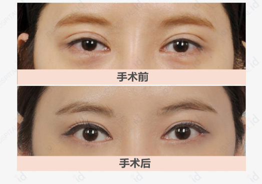 id韩国整形医院双眼皮修复手术对比照片
