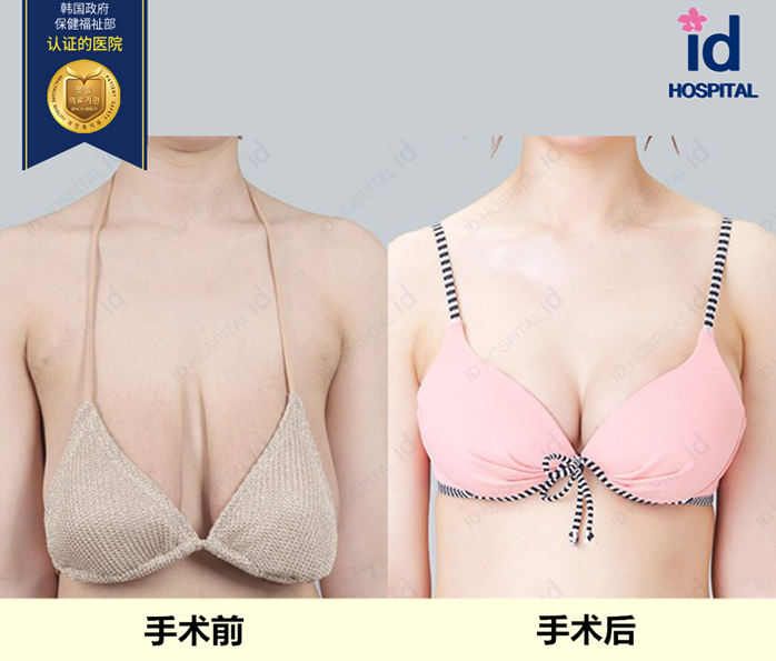 id韩国整形医院下垂胸部矫正前后对比照片