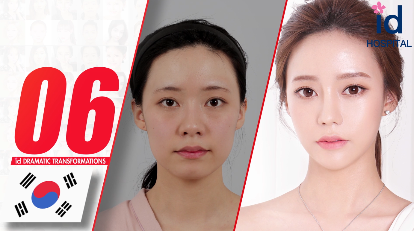 韩国女神整形医院颧骨费用及颧骨内推失败修复病例展示,颌面对比照-8682赴韩整形网