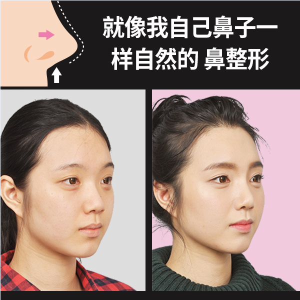 韓国 鼻整形 費用 韓国での鼻整形の費用は？韓国の鼻整形で有名なクリニック情報まとめ