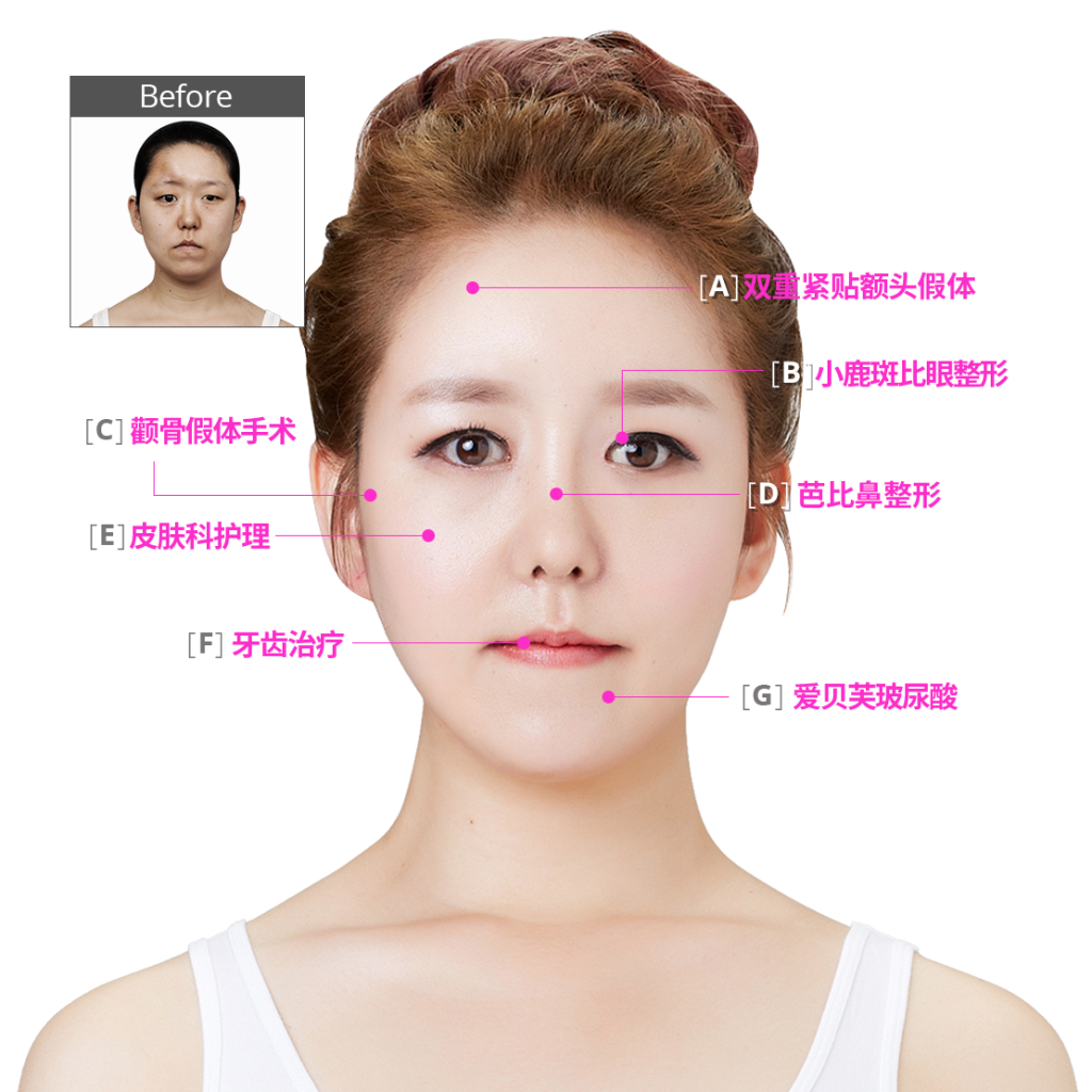 男士整容变女脸前后照片，韩国id整形男变女整形惊艳你,口唇对比照-8682赴韩整形网