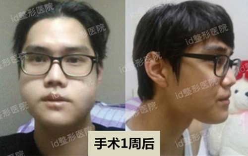 韩国id医院双鄂手术，下颌角整形手术一周后